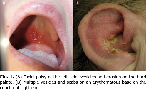 Tampak ruam dan vesikel dengan dasar kemerahan pada palatum durum dan konka telinga  (Stefaniak AA, Knecht K, Matusiak Ł, Szepietowski JC. Sudden Onset of Unilateral Facial Paralysis with Ear Pruritus: A Quiz. Acta Dermato-Venereologica. 2022 Mar 22;102:adv00675.)